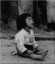 A child burned by Napalm